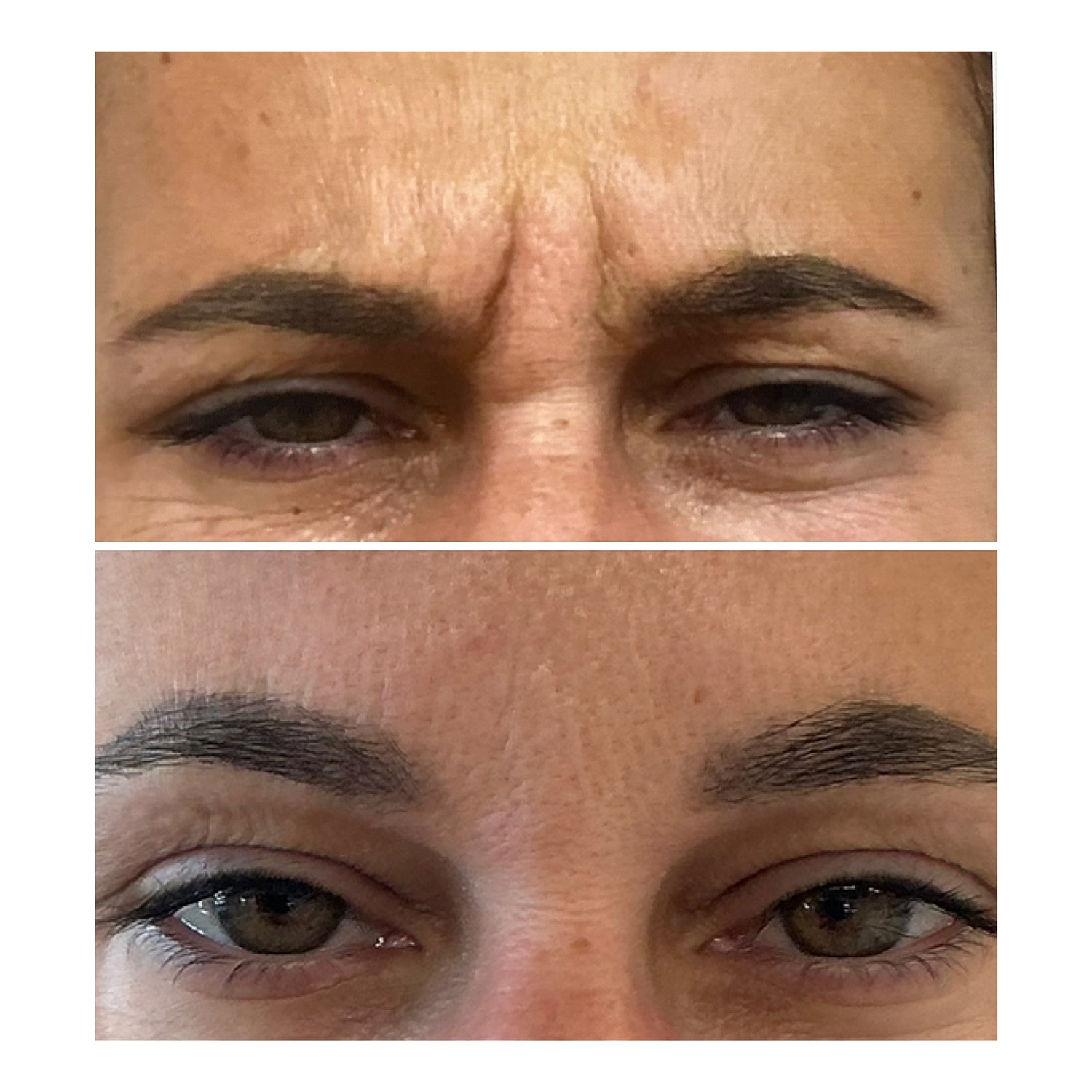 Botox Before & After