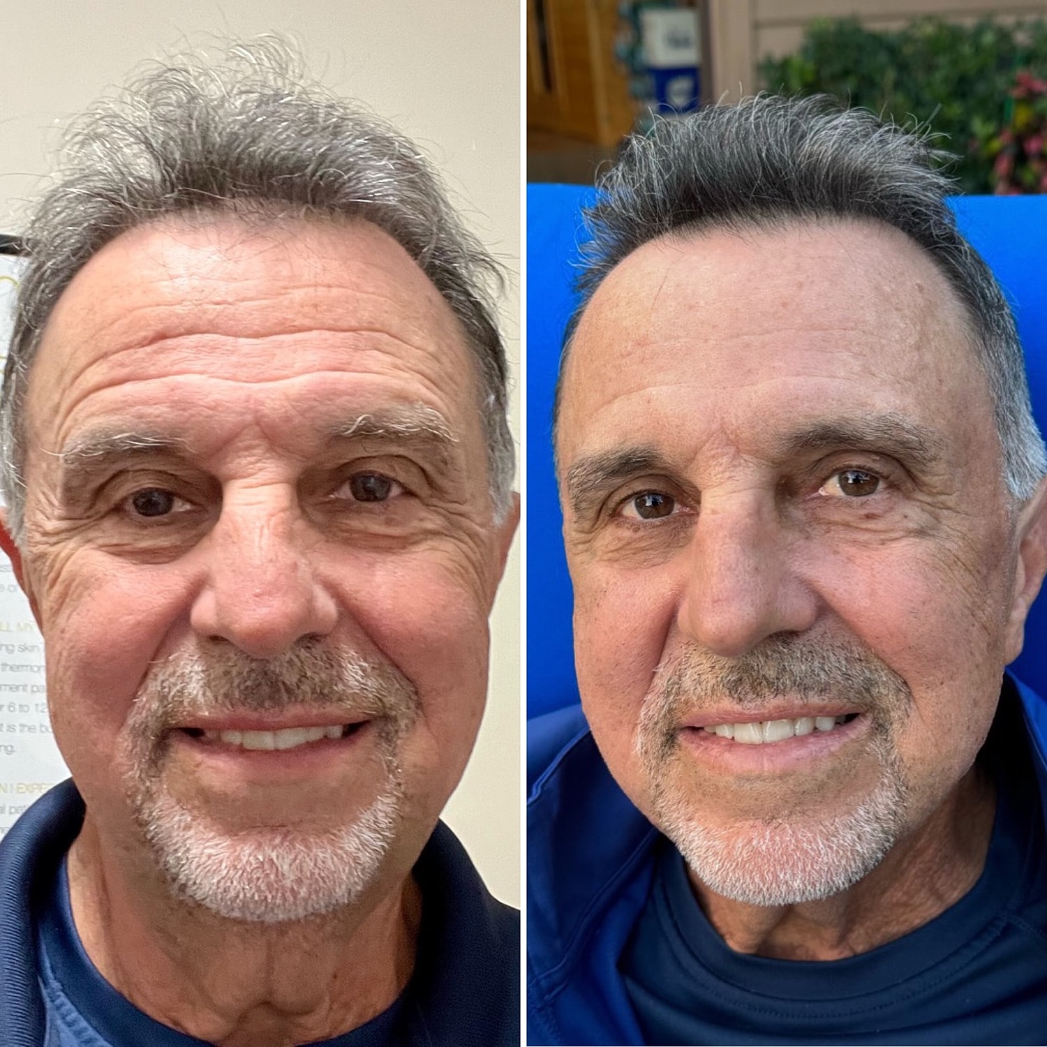 Botox Before & After