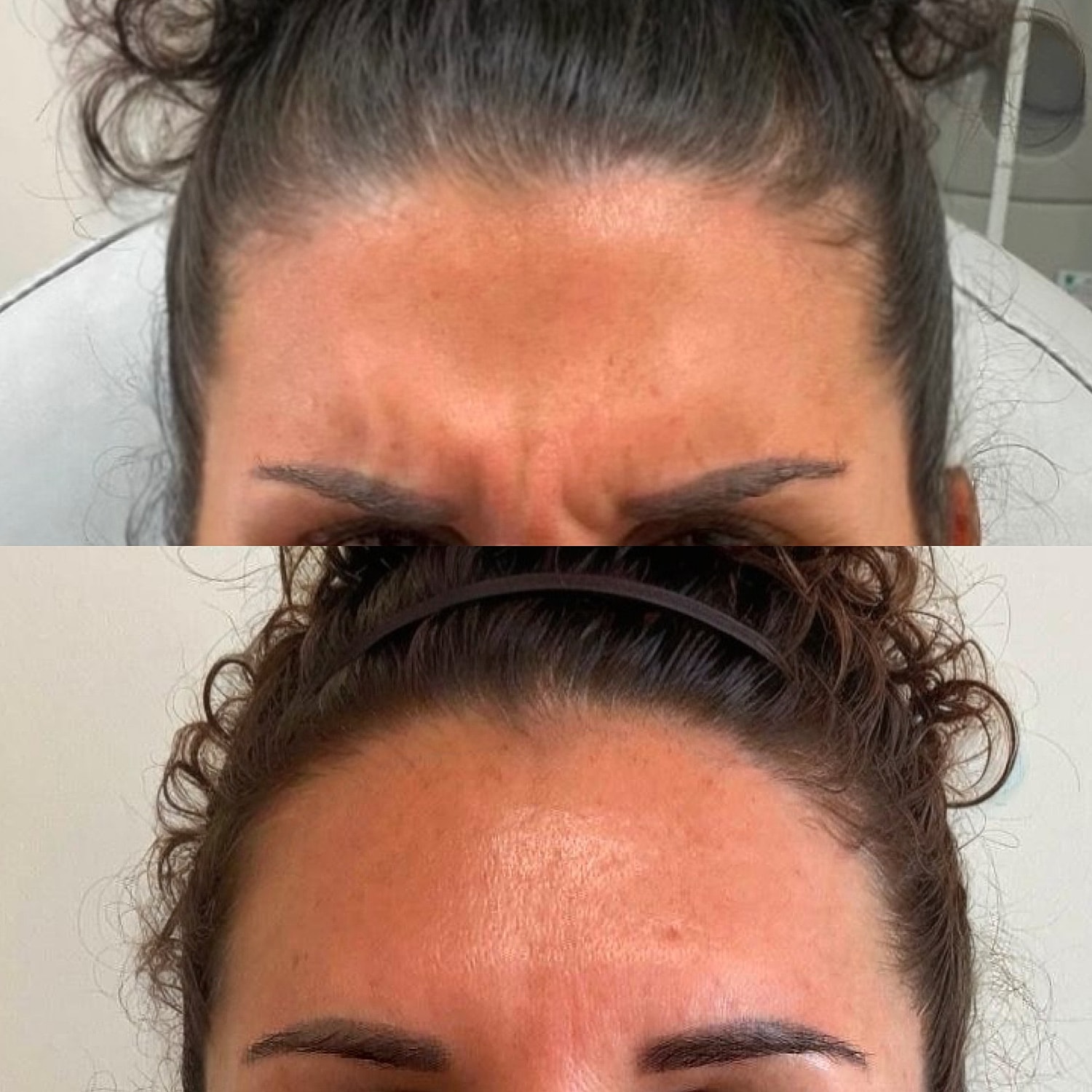 Botox Before & After