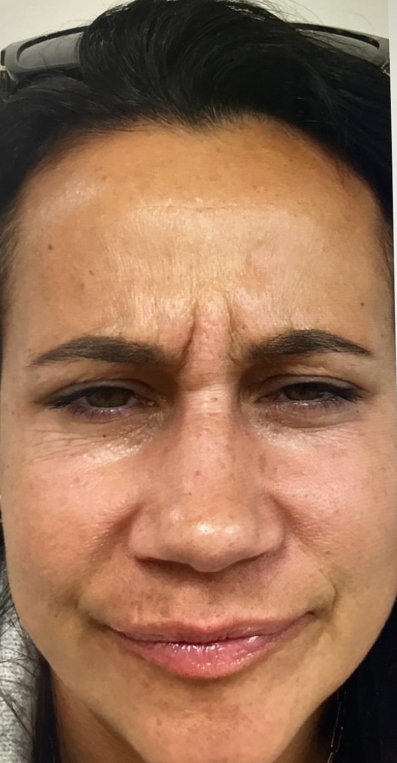 Botox Before & After