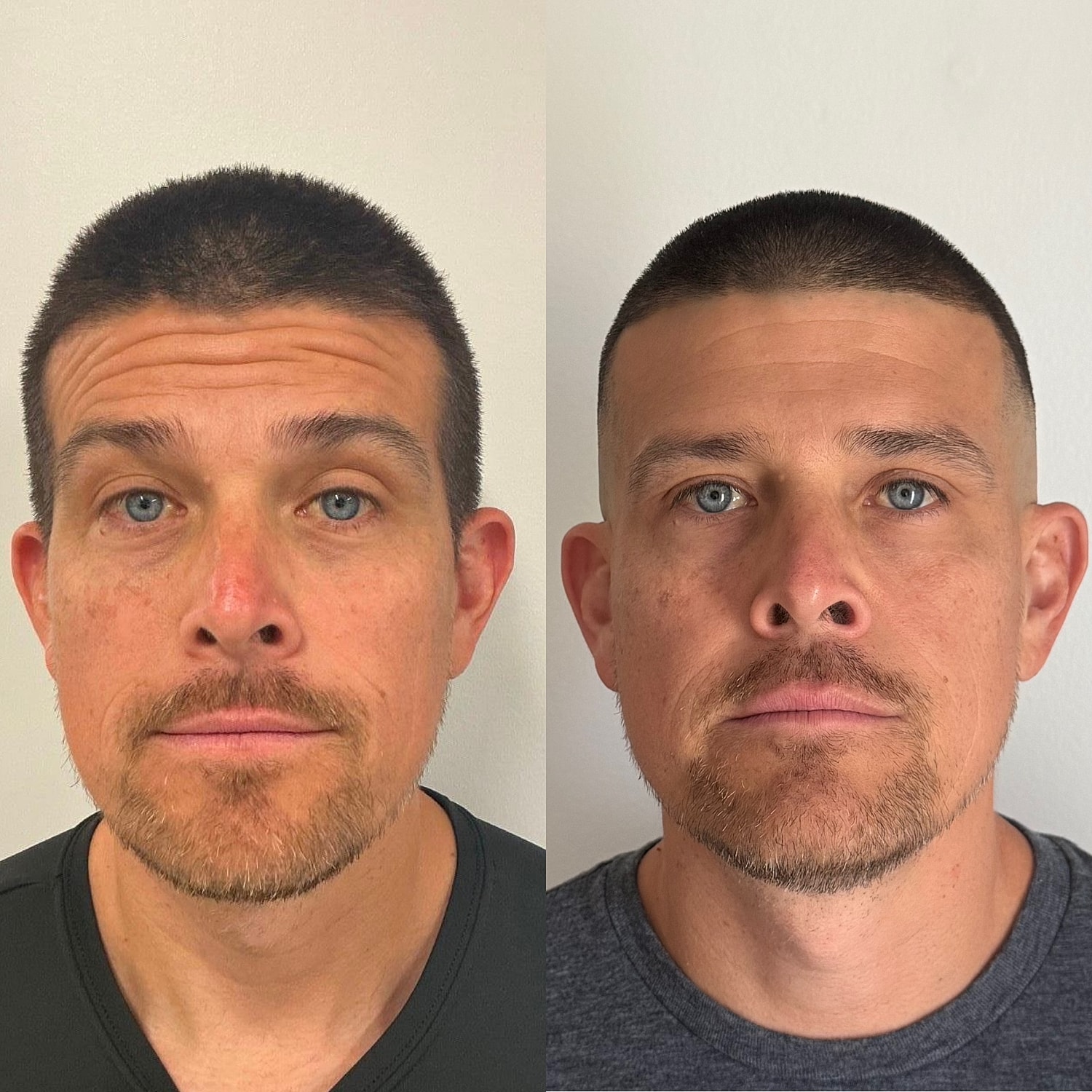 Botox Before & After