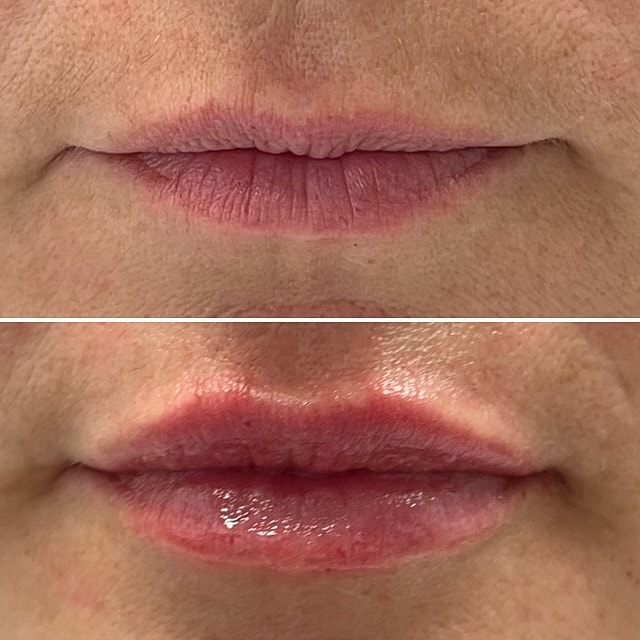 Lip Filler Before & After