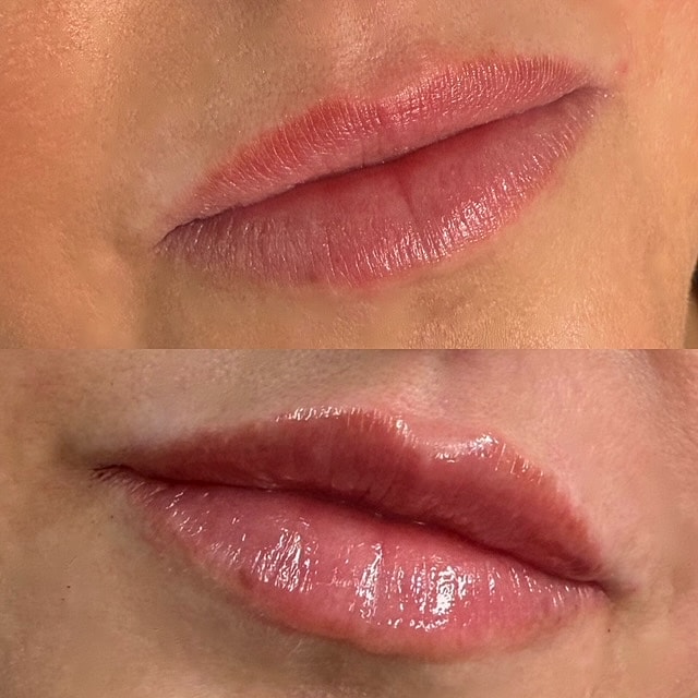 Lip Filler Before & After