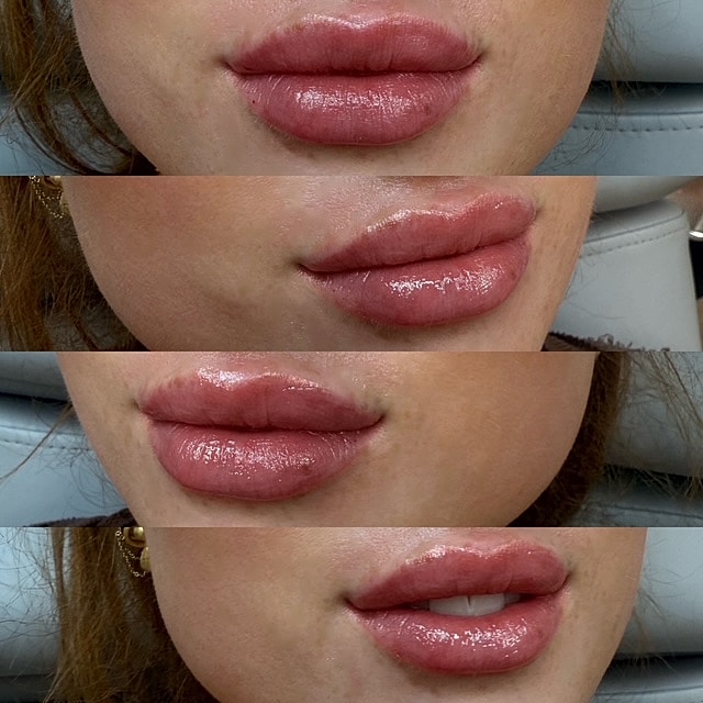 Lip Filler Before & After