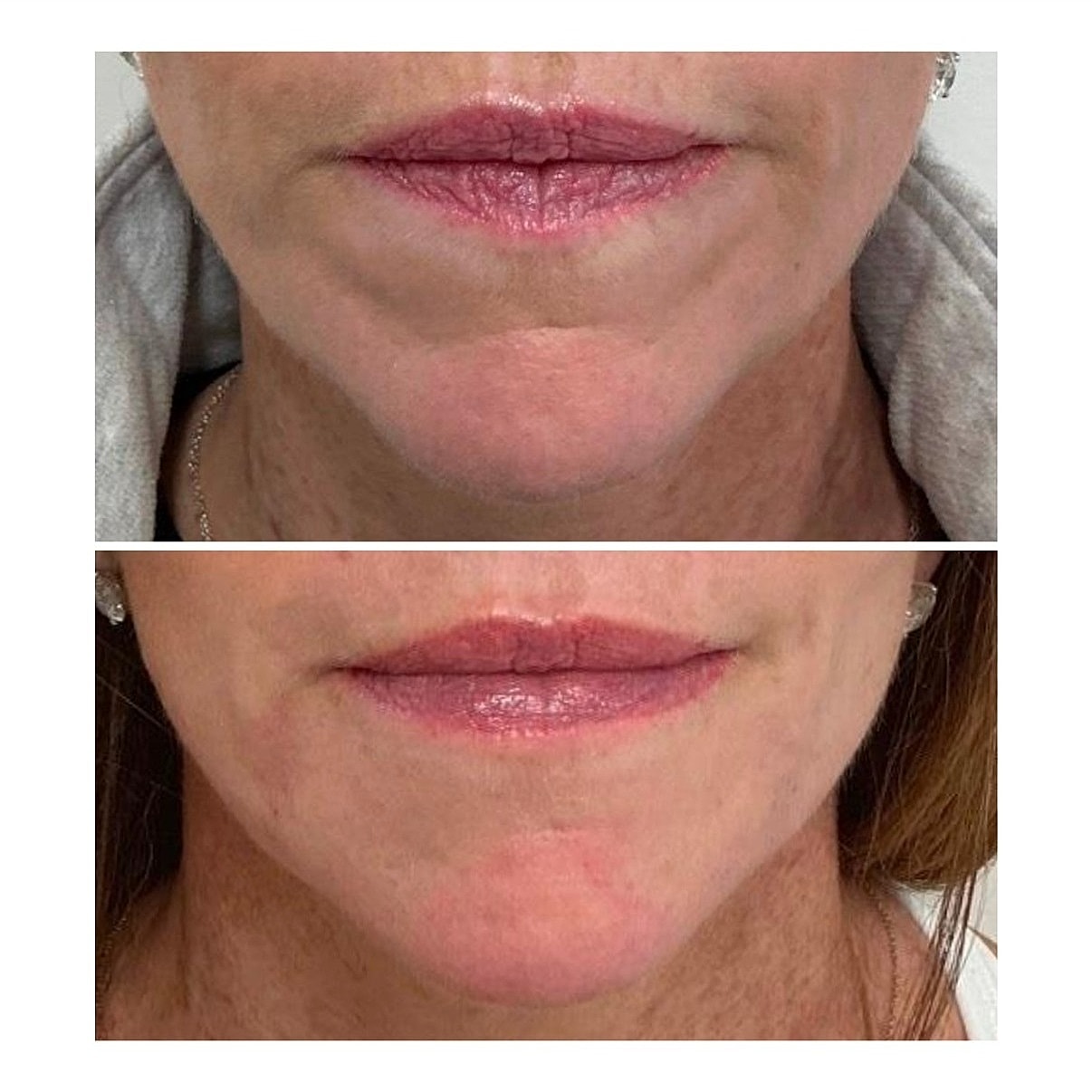 Lip Filler Before & After
