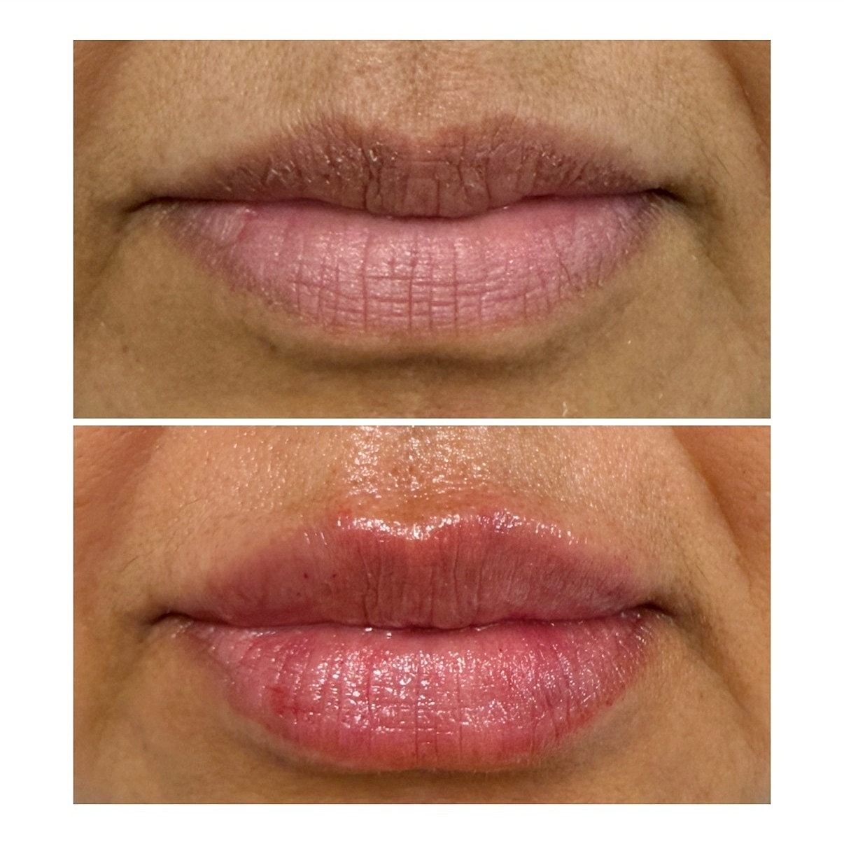 Lip Filler Before & After