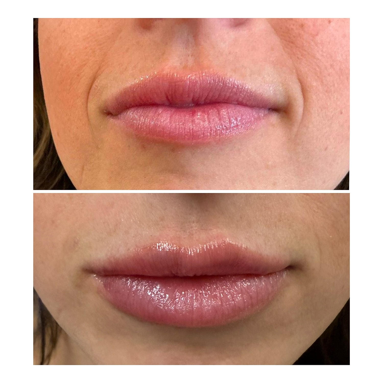 Lip Filler Before & After
