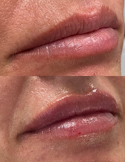 Lip Filler Before & After
