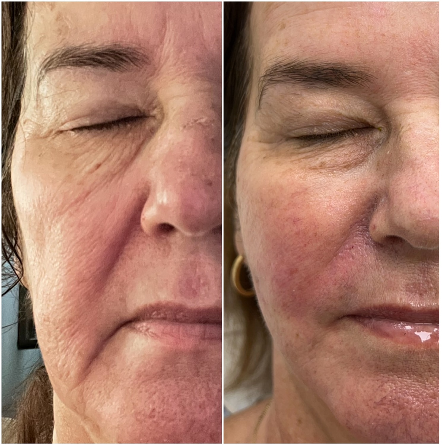 Dermal Fillers Before & After