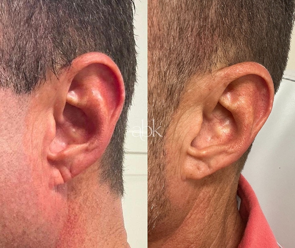 Dermal Fillers Before & After