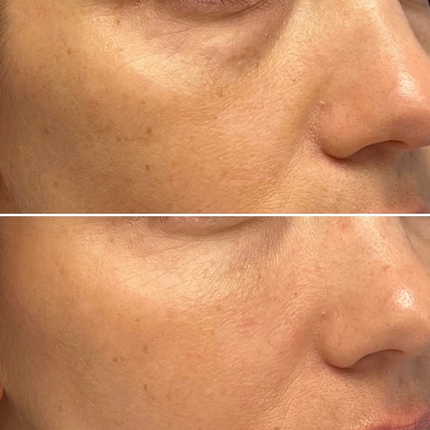 Dermal Fillers Before & After