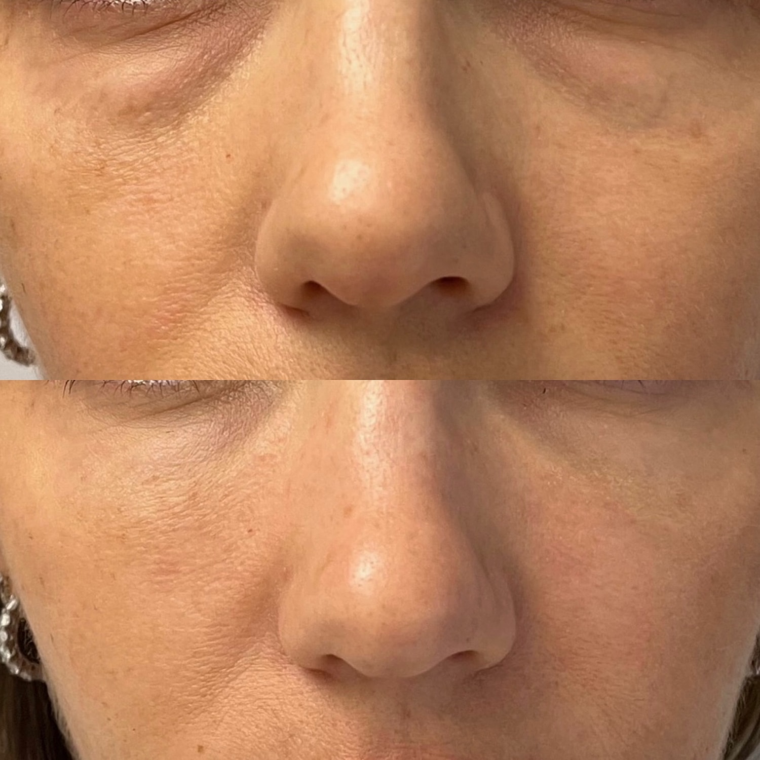 Dermal Fillers Before & After