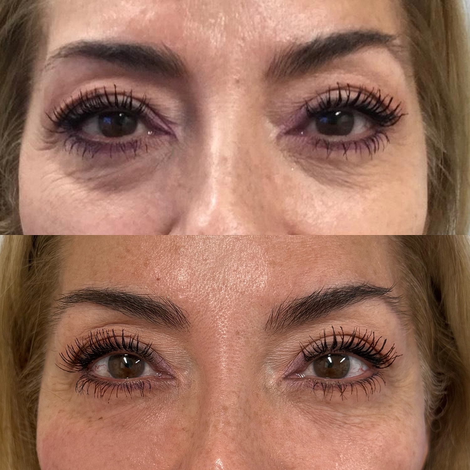 Dermal Fillers Before & After