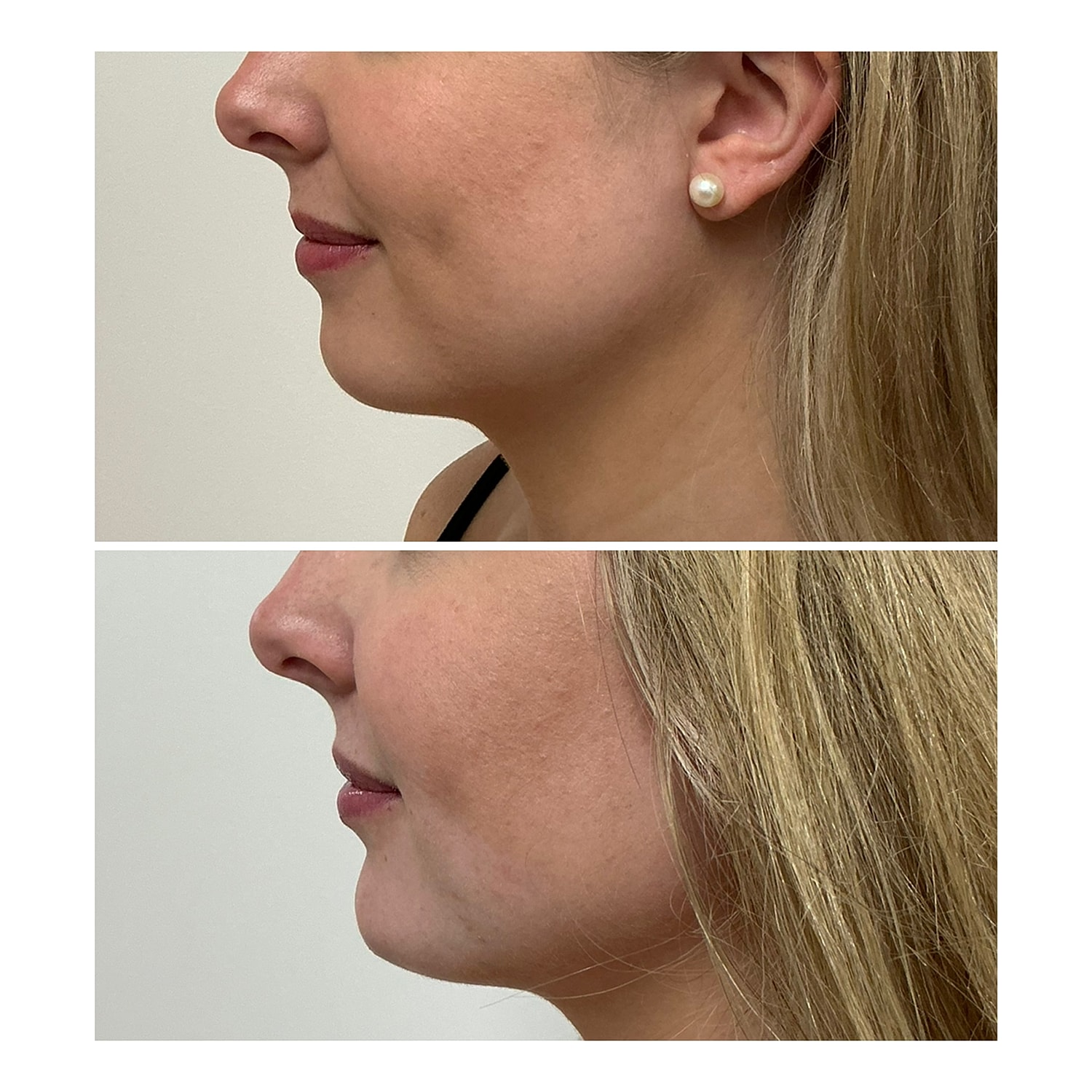 Facial Balancing Before & After