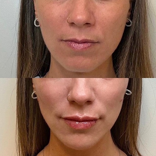 Facial Balancing Before & After